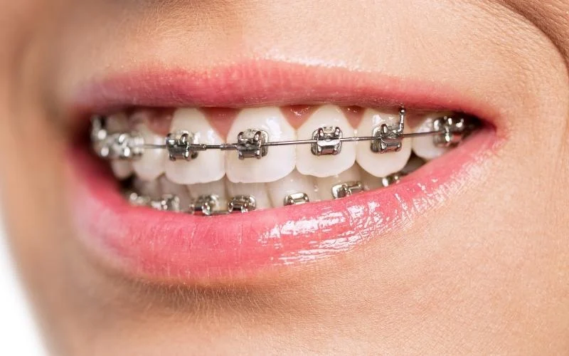 self ligating braces vs conventional braces