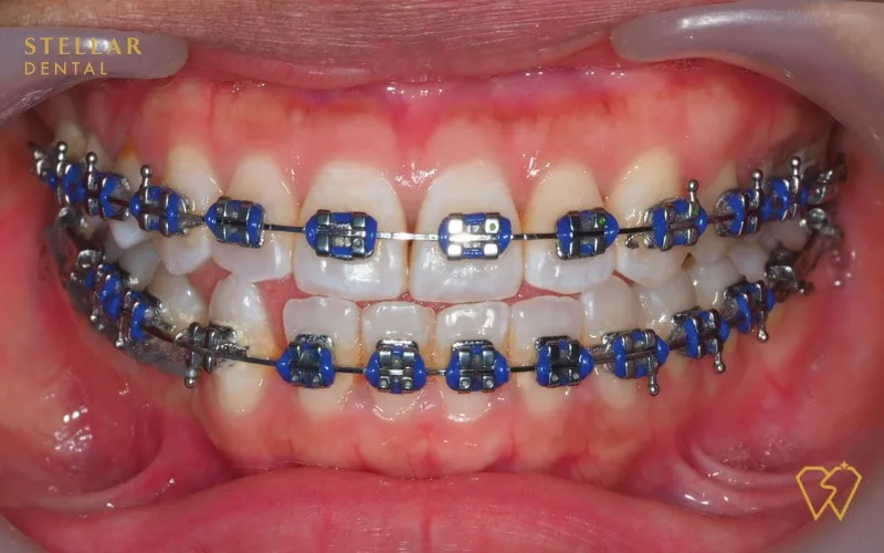 blue colored braces